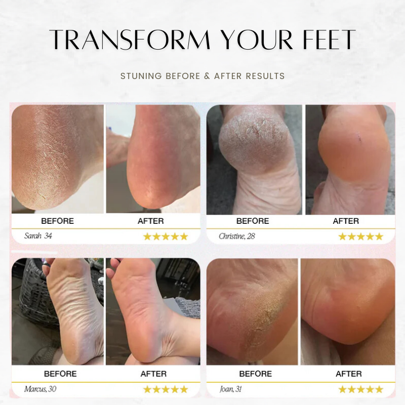 SoftSole™ Callus Remover